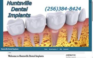 Huntsville Dental Implants